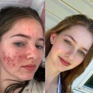 Before and after, eczema/rosacea, healed with a carnivore diet